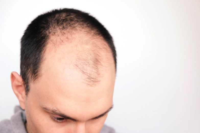 Compounding Medication for Alopecia