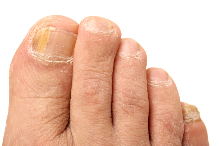 Compounding Medication for Nail-Fungus