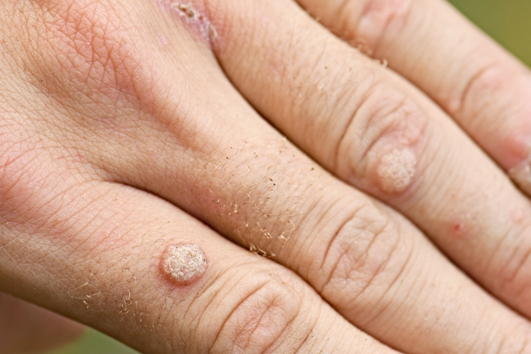 Compounding Medication for Warts