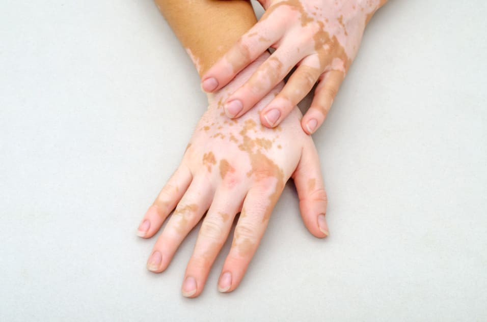 Compounding Medication for vitiligo
